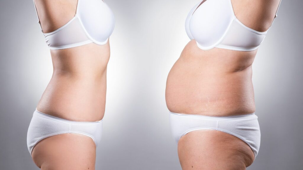 Cosmetic Surgery After Weight Loss