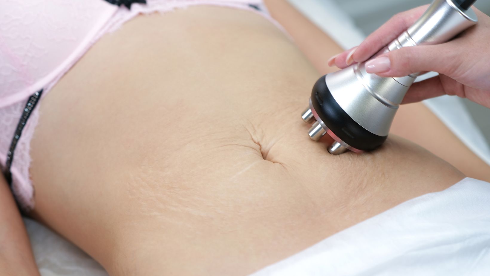 Laser Treatment for Stretch Marks