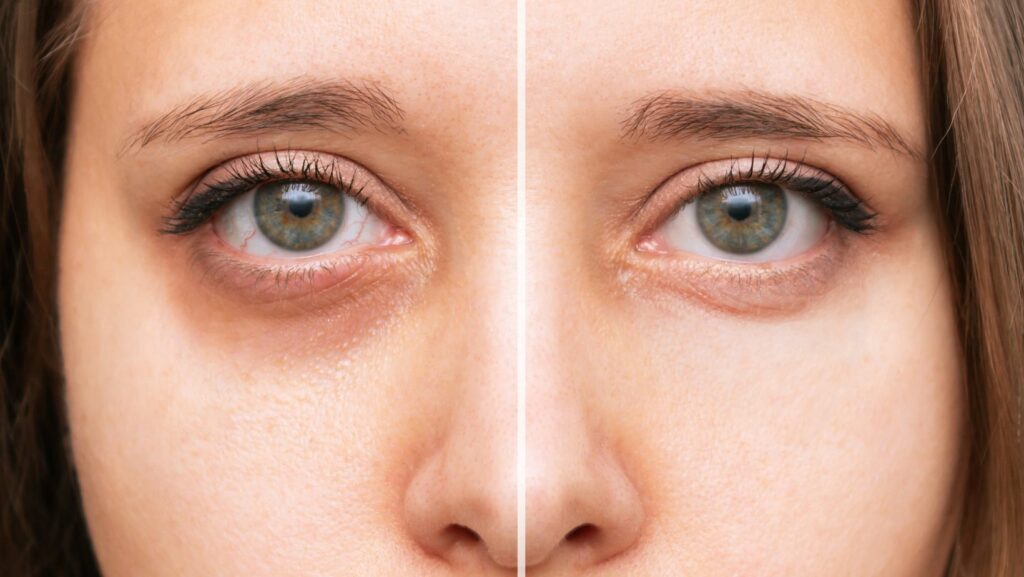 Cosmetic Procedures for Dark Circles